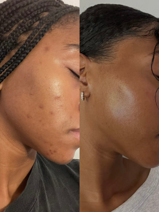 Custom Acne Skincare Plan